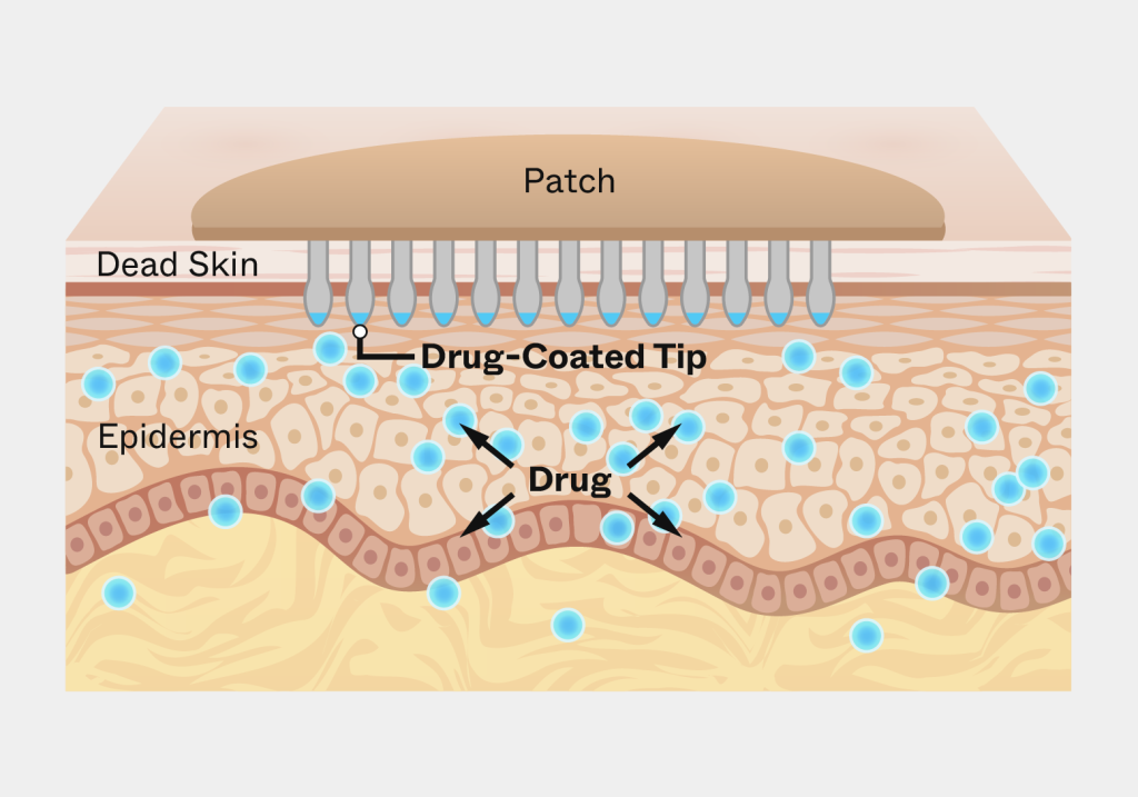 Diagram of a transdermal patch delivering medication through the skin with drug-coated tips penetrating the epidermis.